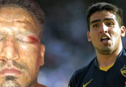 Sifətində fişəng partlayan məşhur futbolçu tanınmaz hala düşdü - FOTO